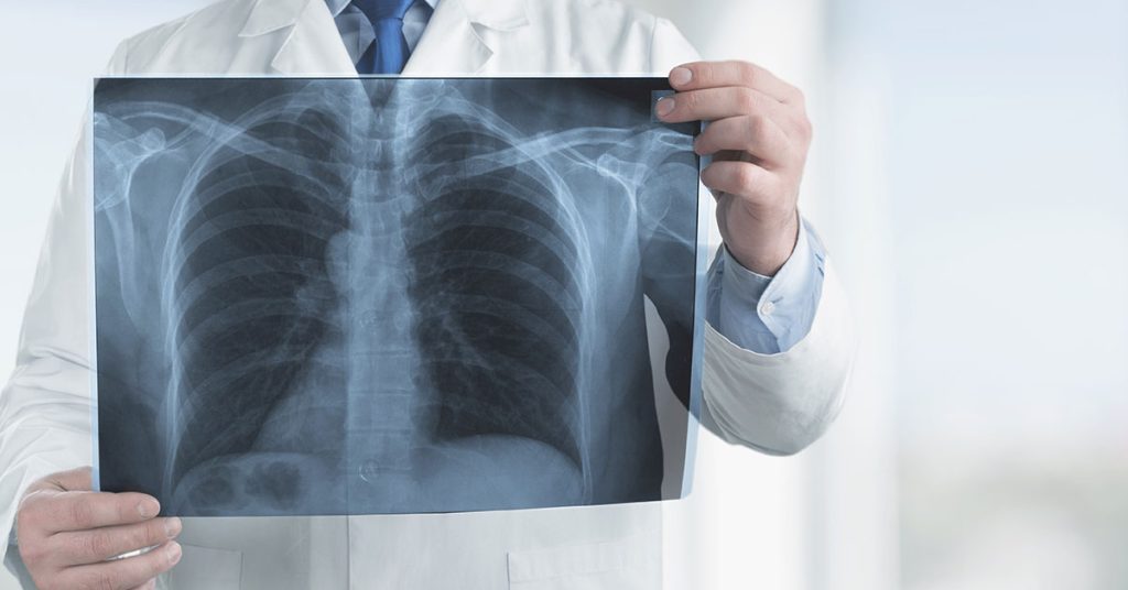 Does Smoking Cause Pulmonary Fibrosis?