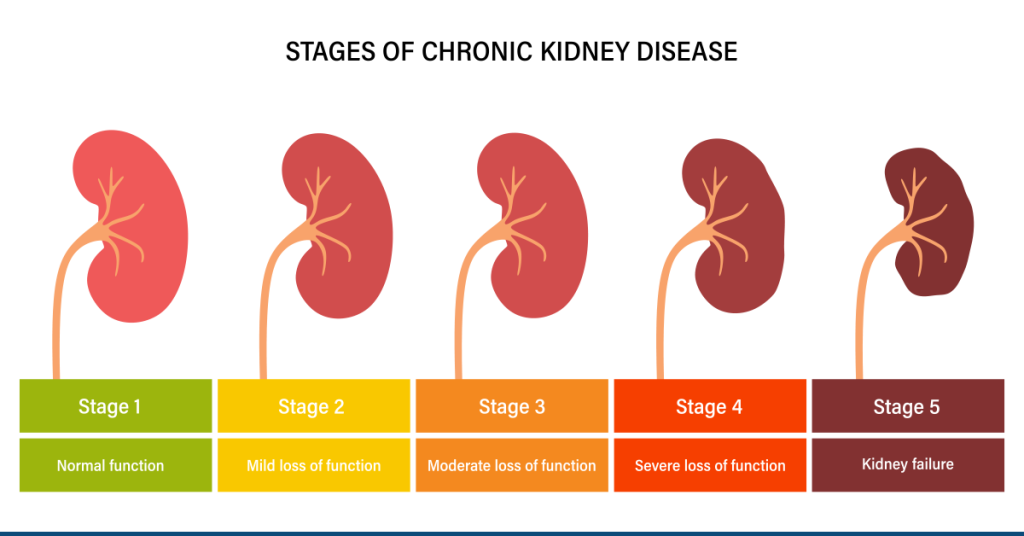 What Are The 5 Stages Of Chronic Kidney Disease 