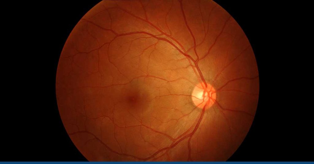 Hypertensive Retinopathy - Symptoms, Diagnosis, Stages and More